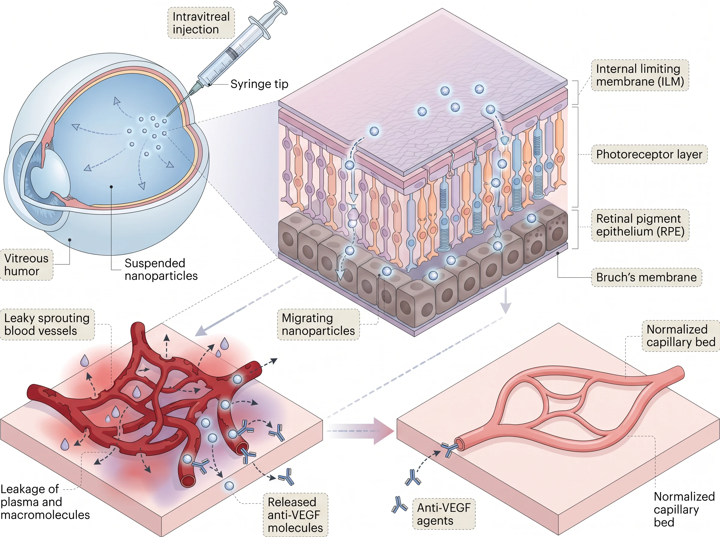 Retinal Nanoparticle Drug Delivery